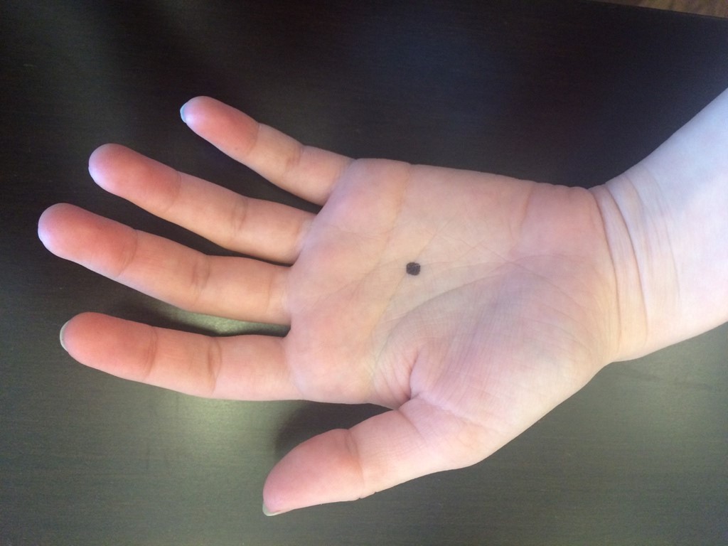 Nốt ruồi ở chính giữa lòng bàn tay báo hiệu điều gì?
